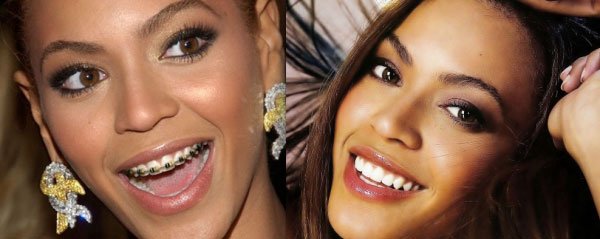 celebridades-brackets10