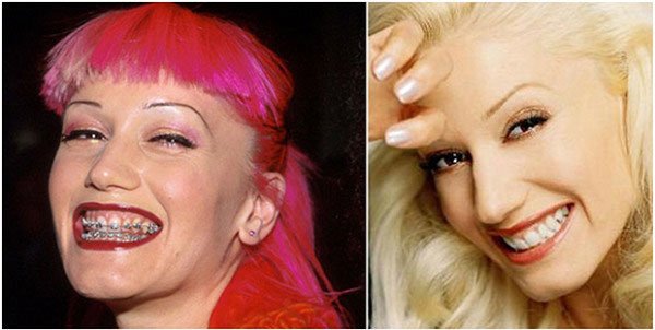 celebridades-brackets7